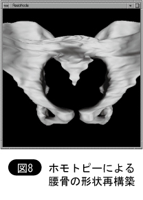 ホモトピーによる腰骨の経常再構築